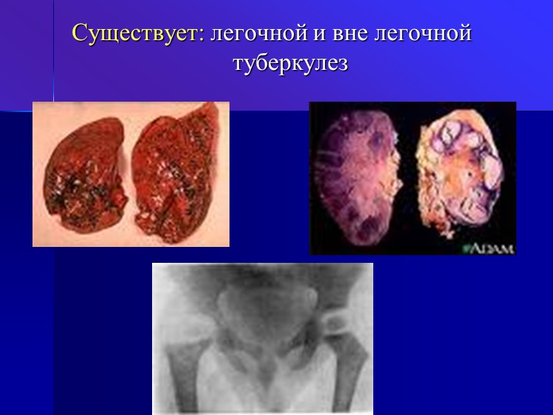 Существует: легочной и вне легочной         